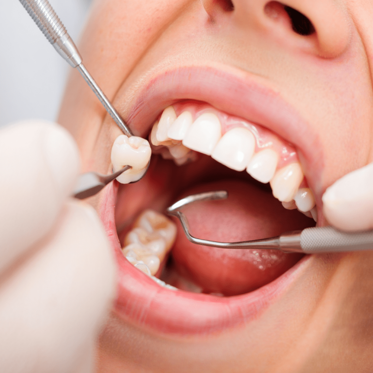 20’lik Diş Çekimi-min