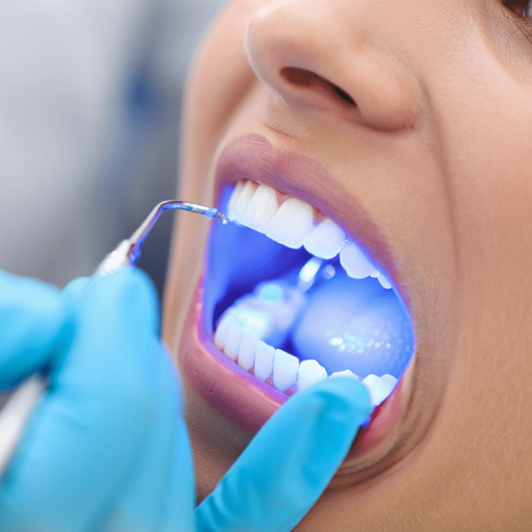 Diş Beyazlatma (Bleaching)-min