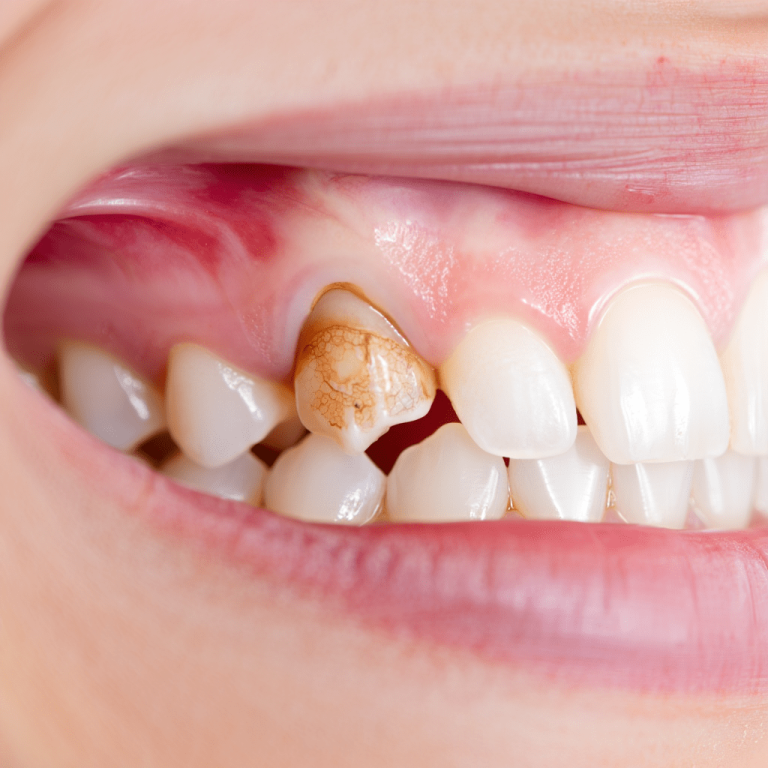 Diş Eti Çekilmesi-min