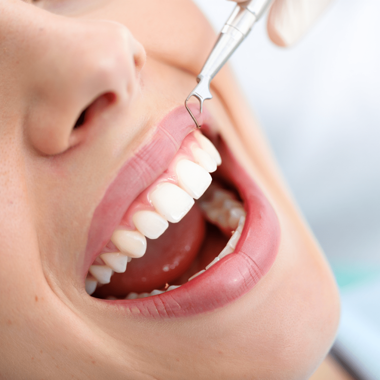 Diş Eti Estetiği-min