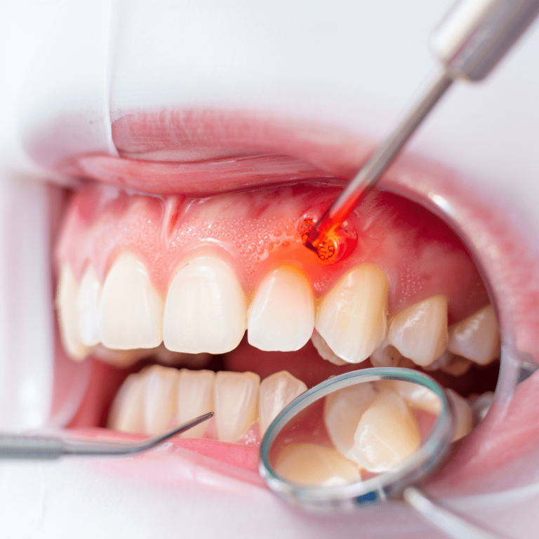 Diş Eti Tedavileri (Periodontoloji)-min