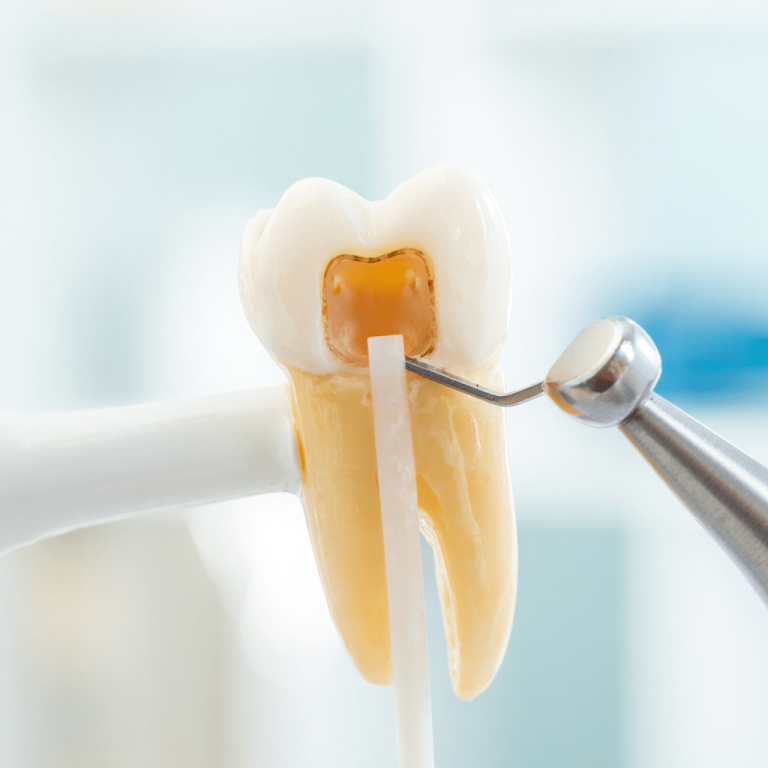 Fiber Post Uygulaması-min