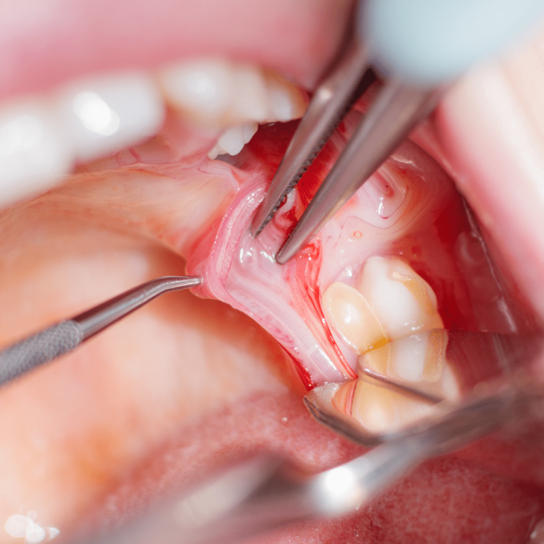 Frenektomi (DudakDil Bağı Kesimi)-min