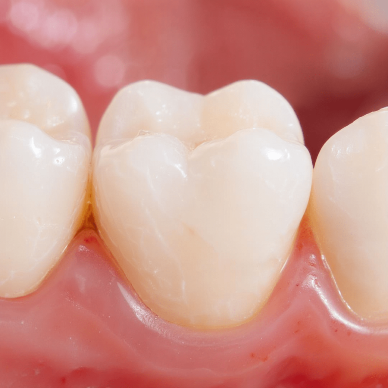 Inlay ve Onlay Diş Restorasyonları-min